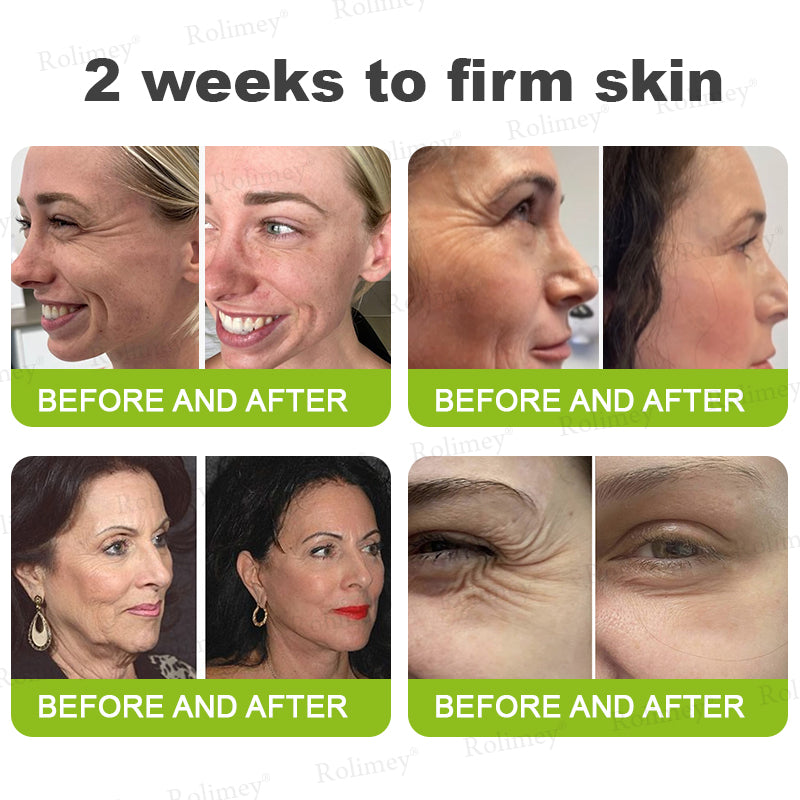 💫👨‍⚕️Made and shipped from the UK 💫Rolimey® Botox & Vita-A Retinol Shot Wrinkle-Lift Tightening cream - Last Day Promotion 70% OFF