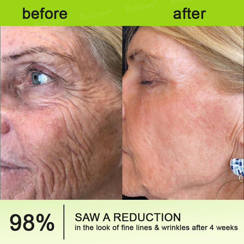 💫👨‍⚕️Made and shipped from the UK 💫Rolimey® Botox & Vita-A Retinol Shot Wrinkle-Lift Tightening cream - Last Day Promotion 70% OFF